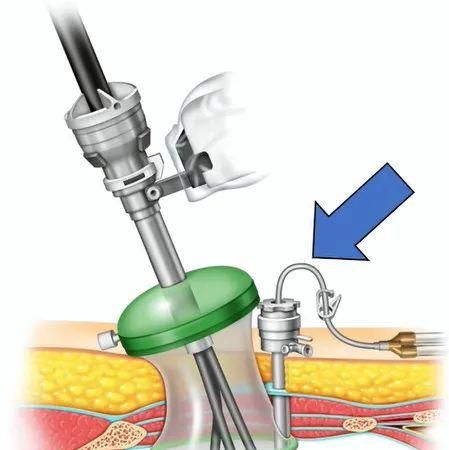 单端口机器人手术：一般原理和故障排除图5